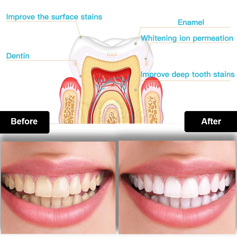 Diş Diş Beyazlatma Kiti Mini 1 - Teeth Whitening Laser incelemesi ve fiyatı
